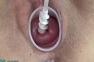 Milf cervix insertion with spiral catheter for insemination and vibrator jav extreme