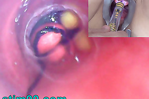 Mature Woman, Peehole Endoscope Camera on every side Bladder thither Natter on